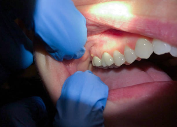 Best Emergency Dentist for Lost Fillings or Crowns in Bay Springs, MS